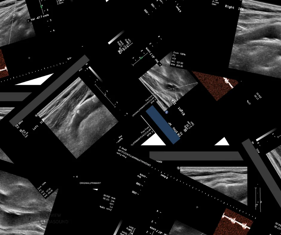 Understanding Carotid Ultrasounds