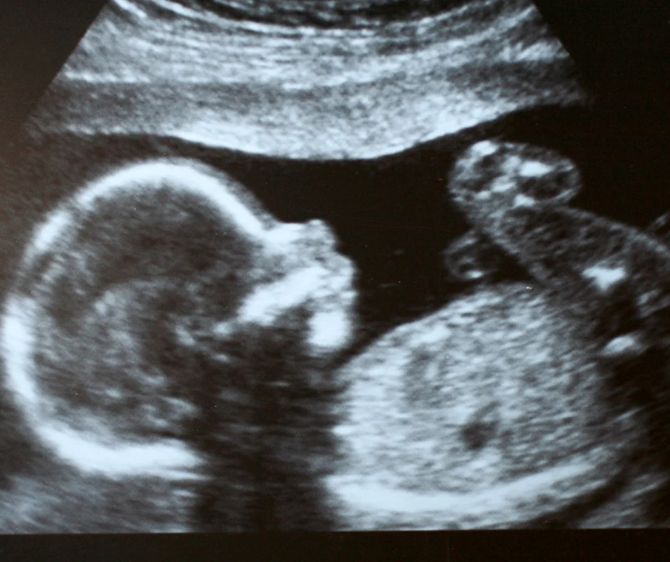 prepare siblings for 3D ultrasound