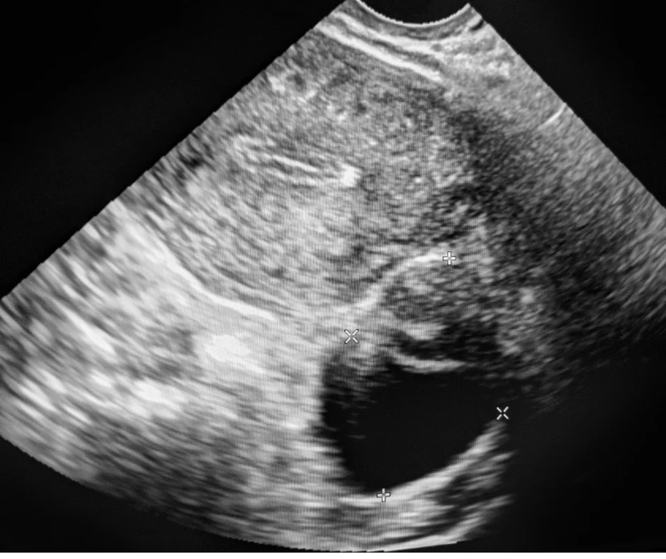How Ultrasounds Detect Gallstones, Tumors, and Other Hidden Health Threats