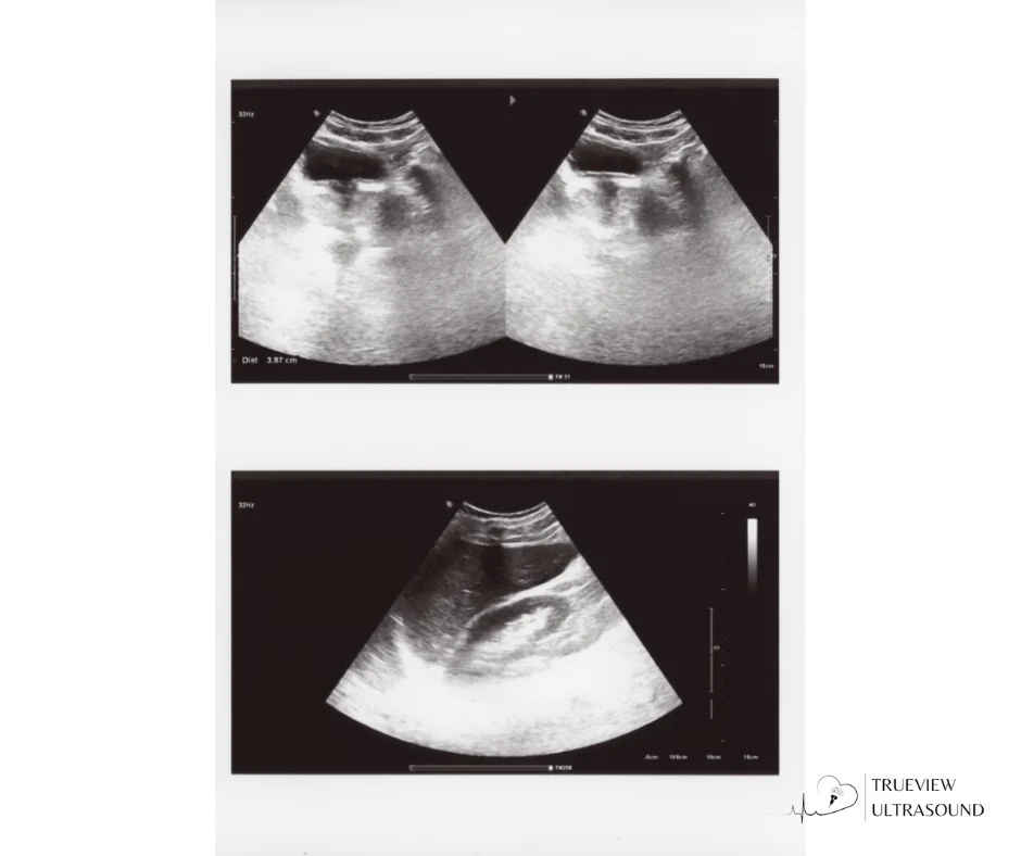 ultrasound safety and early detection