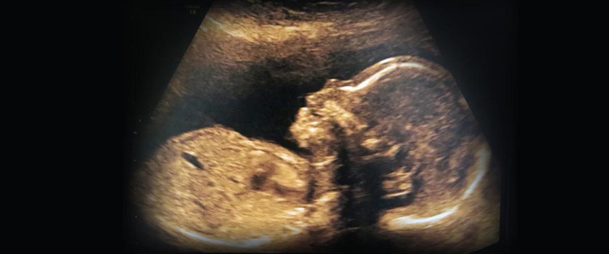 Top Questions to Ask at Your 20-Week Anatomy Scan in Roseville