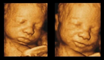 Future of Ultrasound: AI, 4D Imaging & Multimodal Advances
